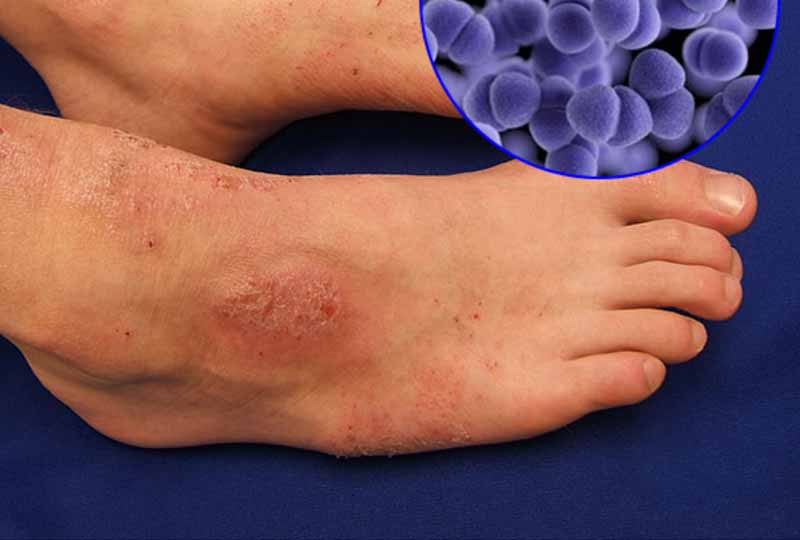 Da chân không được chăm sóc dễ sần sùi và nhiễm trùng