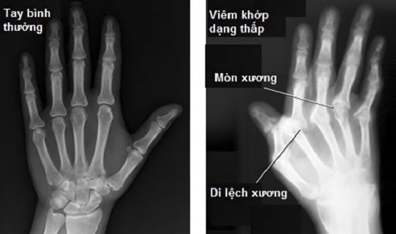 Hình ảnh trên X-quang cho thấy các khớp bị biến dạng do viêm khớp dạng thấp gây ra