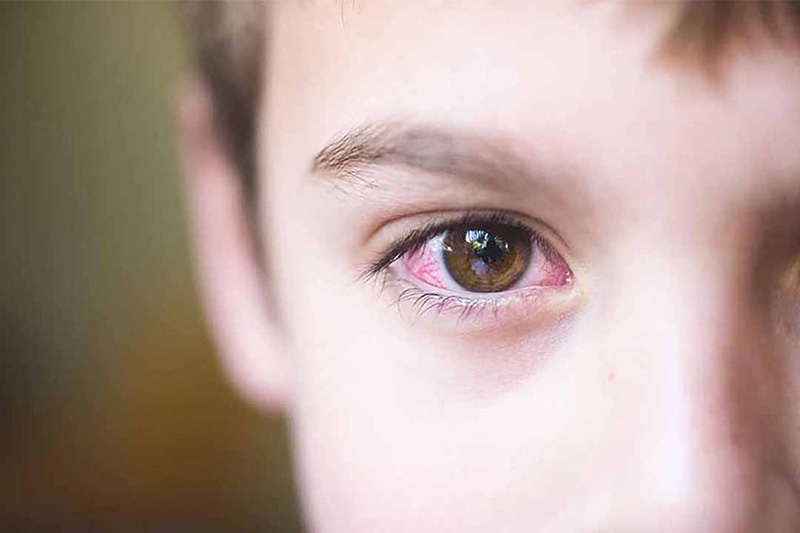 Thiếu vitamin A khiến mắt dễ khô mỏi