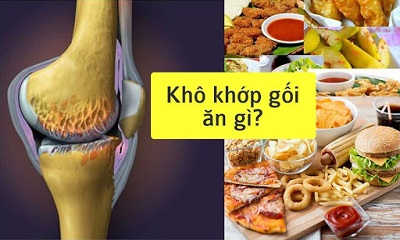 Người bị bệnh khô khớp gối nên ăn gì là vấn đề cần được quan tâm