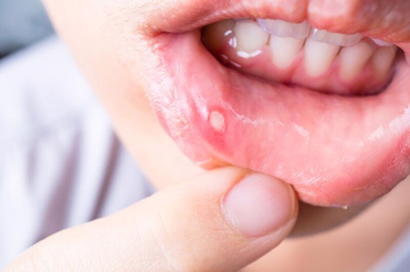 Sử dụng thuốc nhiệt đúng cách, chăm sóc răng miệng cẩn thận
