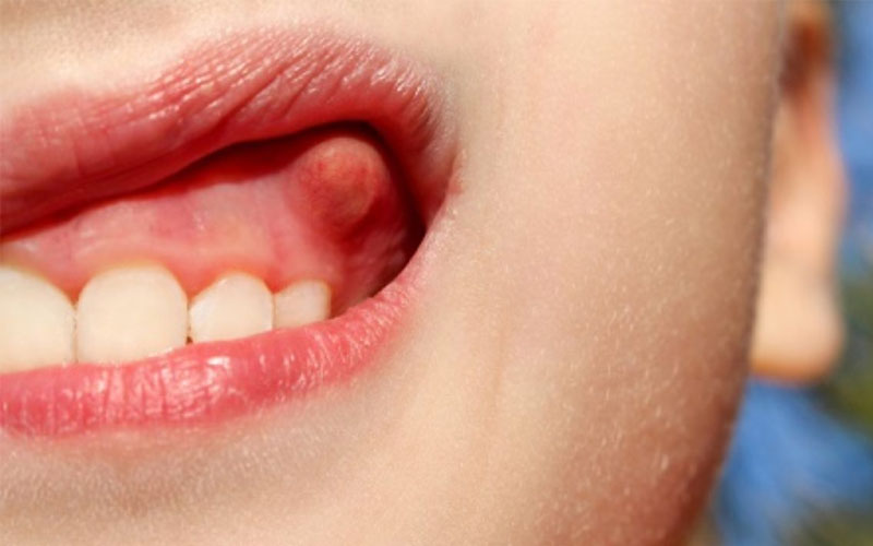 Trẻ nhỏ là đối tượng dễ gặp phải những vấn đề liên quan đến răng miệng