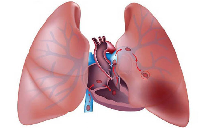 Thuyên tắc phổi là nguyên nhân khiến tim đập nhanh, bệnh nhân bị tức ngực khó thở