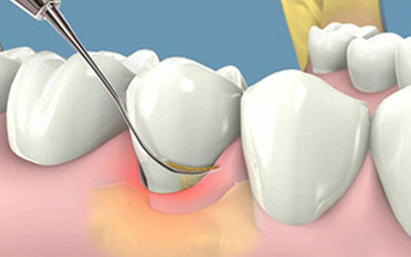 Lấy cao răng để điều trị bệnh