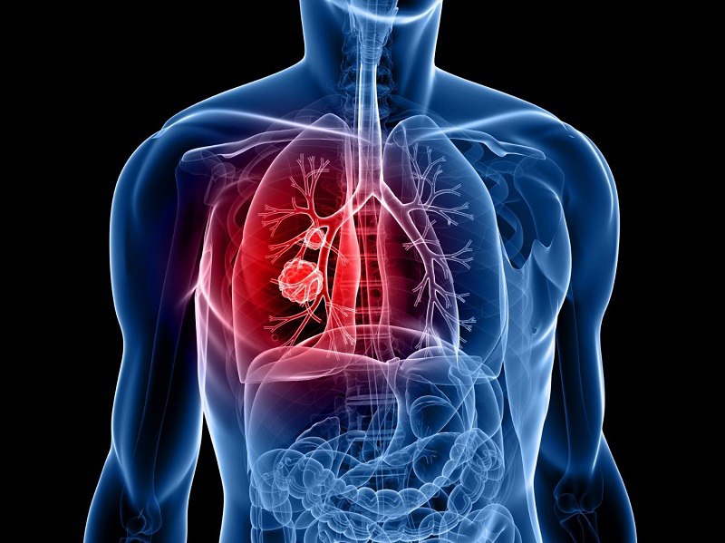 Những người bị suy tim hoặc ung thư phổi cần được điều trị theo phác đồ của bác sĩ