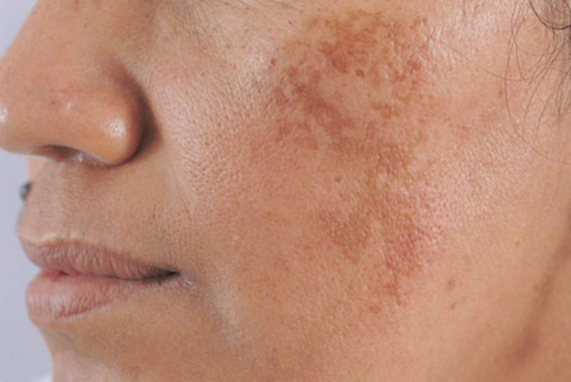 Nám da mặt vùng má là tính trạng tương đối phổ biến