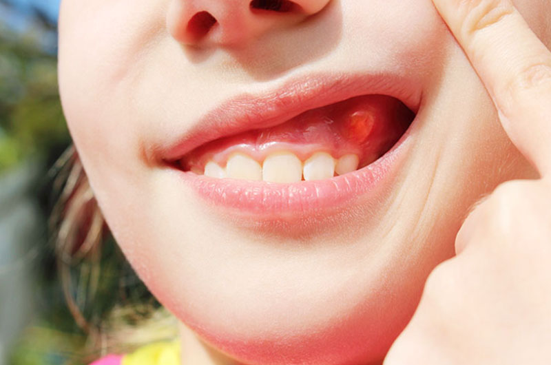 Sưng nướu răng có mủ là tình trạng nhiễm trùng nướu, dẫn tới hình thành ổ mủ quanh chân răng gây đau nhức