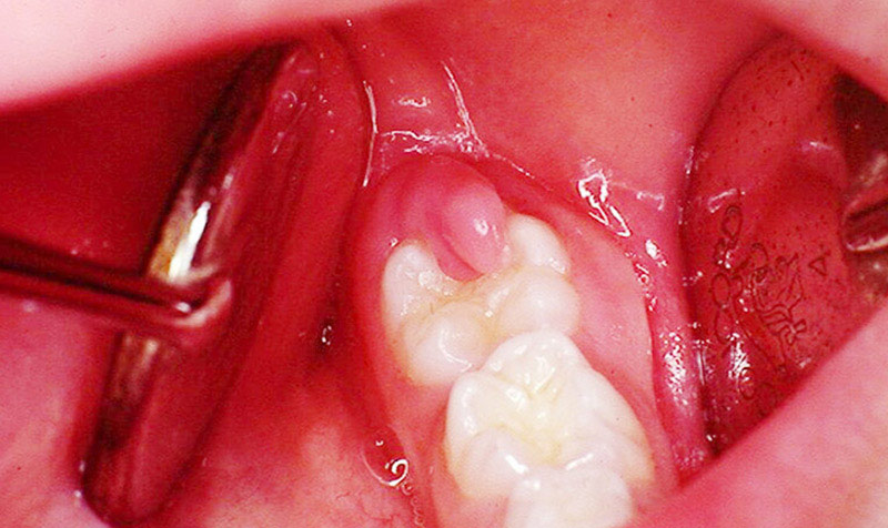 Vùng nướu răng khôn bị sưng tấy đỏ hơn các vùng nướu khác