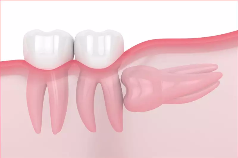 Khi răng khôn mọc ngang bắt buộc phải nhổ để không ảnh hưởng tới răng bên cạnh