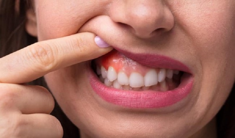 Viêm lợi nổi hạch có thể do mọc răng khôn hoặc một số bệnh lý về răng khác