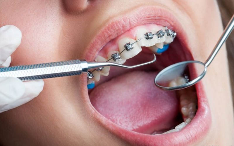 Lấy cao răng để điều trị tình trạng viêm nha chu tốt hơn