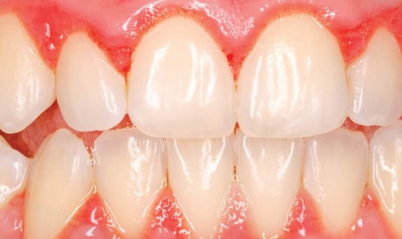 Vệ sinh răng miệng không đúng cách là nguyên nhân chính gây nên tình trạng viêm nướu răng sứ