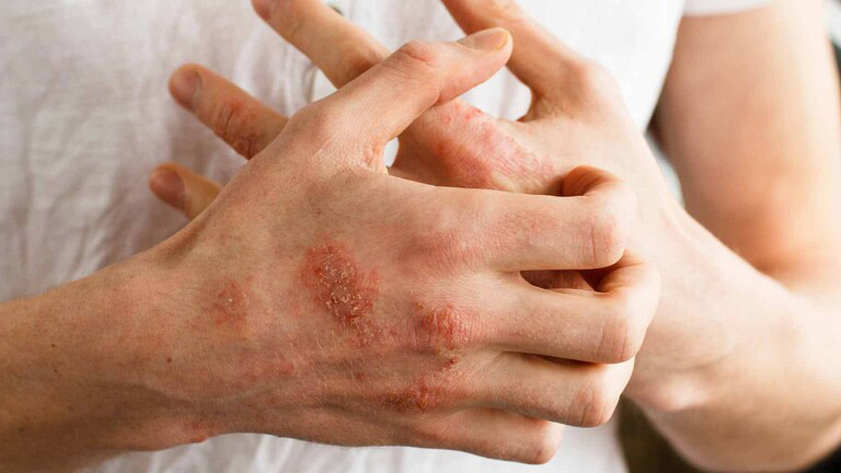 Tuyệt đối không được cào gãi vùng da bị tổn thương để tránh bị bội nhiễm
