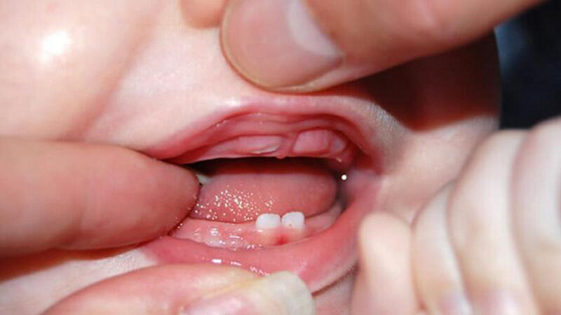 Trẻ mọc răng sữa có thể sử dụng sản phẩm để giảm bứt rứt, khó chịu