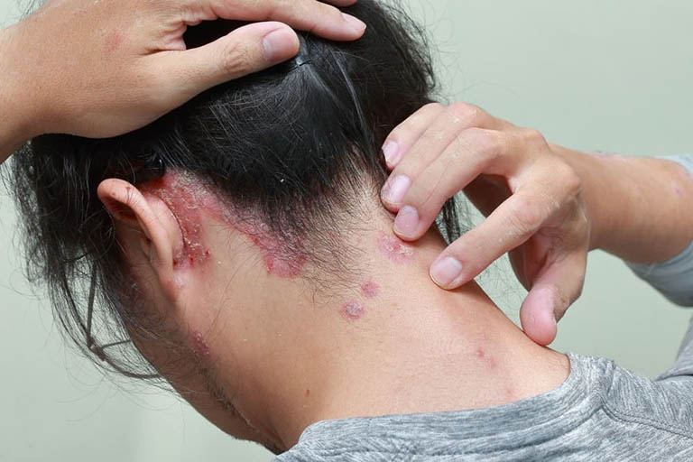 Vảy nến da đầu gây tổn thương mãn tính trên da khiến người bệnh cảm thấy rất khó chịu