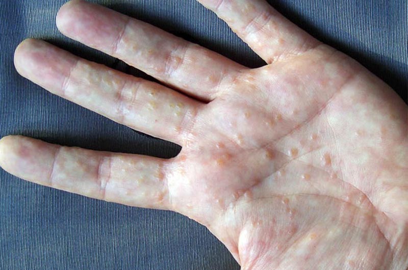 Tổ đỉa là bệnh da liễu thường gặp với đặc trưng là mụn nước nhiều ở tay, chân