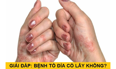 Bệnh Tổ Đỉa Có Lây Không Và Cách Chữa Tốt Nhất Đừng Bỏ Qua