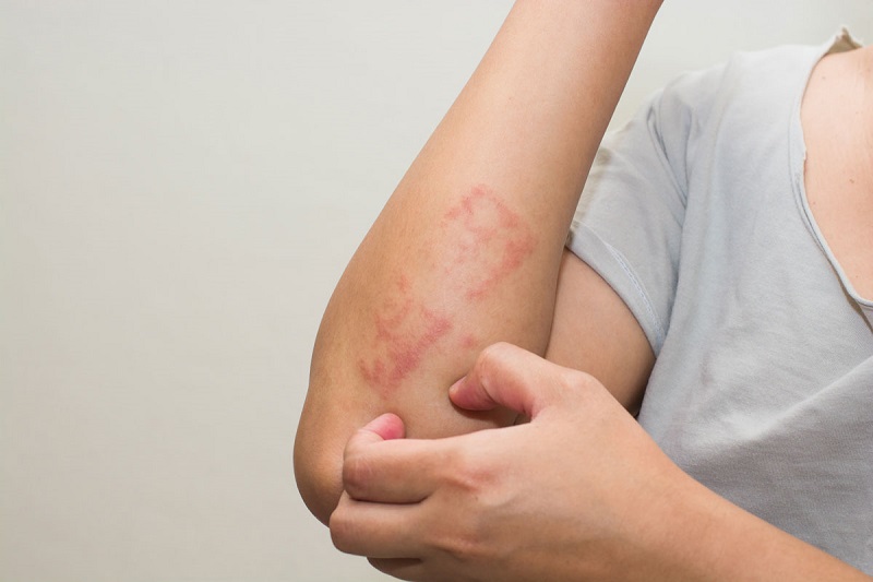 Việc cào gãi nhiều có thể khiến da bị trầy xước và để lại thâm sẹo