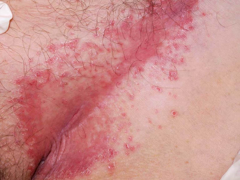Bệnh vảy nến vùng kín gây tổn thương da ở bộ phận sinh dục
