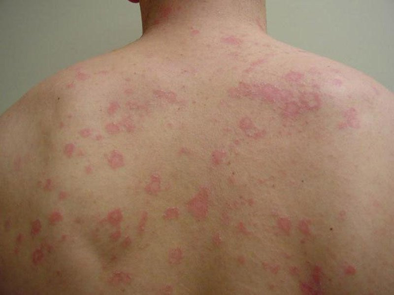 Bệnh đặc trưng bởi những đốm màu hồng nổi rõ trên da