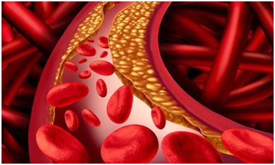 Khi Nào Cần Giảm Cholesterol, Cách Giảm Cholesterol Hiệu Quả