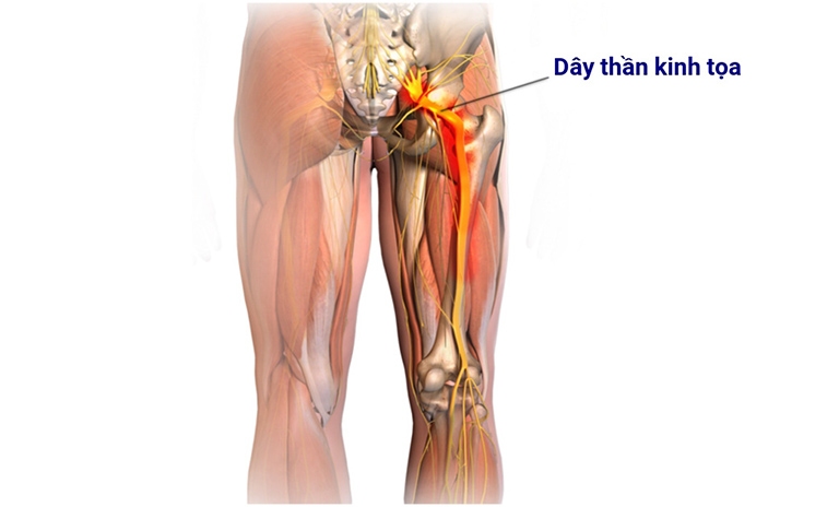 Đau dây thần kinh tọa gây đau nhức từ thắt lưng kéo dài đến chân, ảnh hưởng đến khả năng vận động