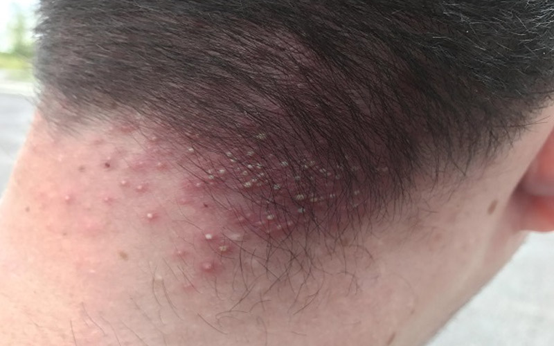 Nhiều trường hợp bị ngứa da đầu do viêm nang lông
