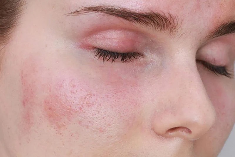 Da mặt bị dị ứng nổi sần ngứa là tình trạng làn da bị phản ứng với các chất gây kích ứng
