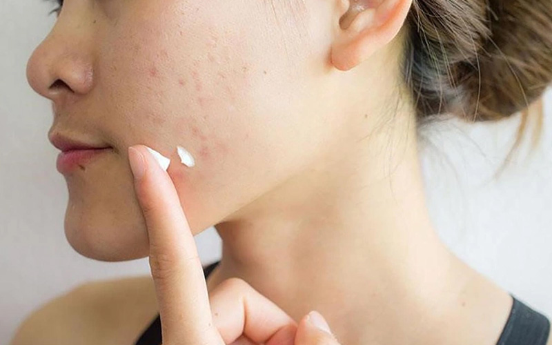 Dùng thuốc Tây trị da mặt bị ngứa và sần sùi