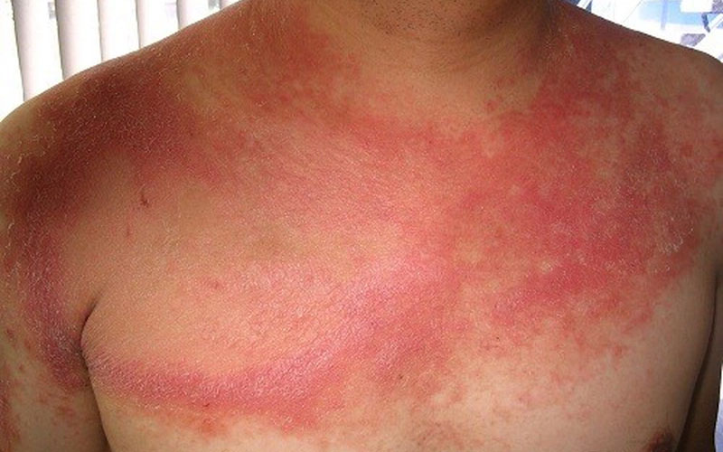 Lupus ban đỏ triệu chứng trên da là phát ban dạng cánh bướm hoặc dạng đĩa