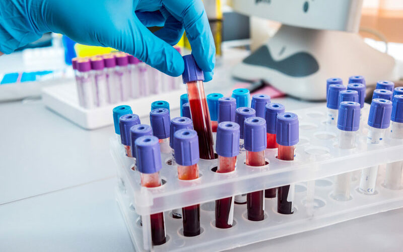 Xét nghiệm máu phát hiện bệnh lupus ban đỏ