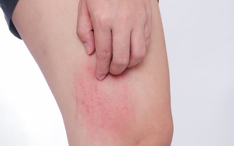 Ngứa da có thể là dấu hiệu quả một số bệnh lý ngoài da