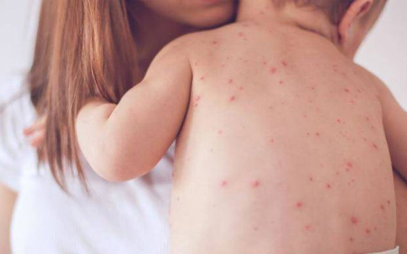 Trẻ bị phát ban sau sốt cần kiêng gãi lên vùng da đang ngứa
