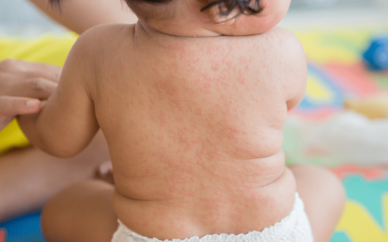 Chuyên gia tại Dr.Vitamin khẳng định trẻ phát ban sau sốt hoàn toàn có thể tắm được