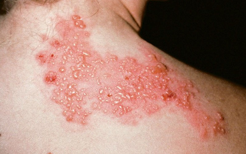 Bệnh zona thần kinh có thể làm xuất hiện các vết đỏ trên da không ngứa