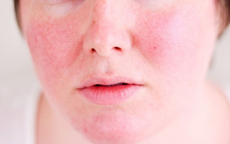 Sau khi peel da, nhiều người gặp tình trạng ngứa ngáy, khô ráp da