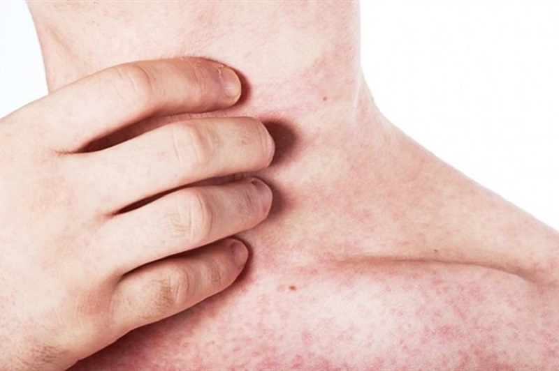 Nổi phát ban sau sốt ở người lớn là tình trạng xuất hiện các nốt ban trên da