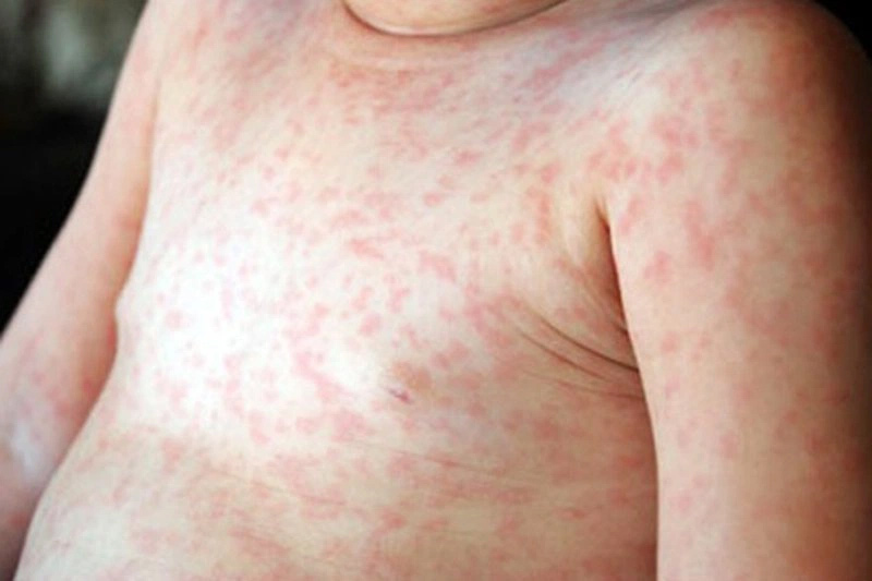 Tình trạng trẻ phát ban đỏ sau sốt có thể kéo dài khoảng 5 - 7 ngày