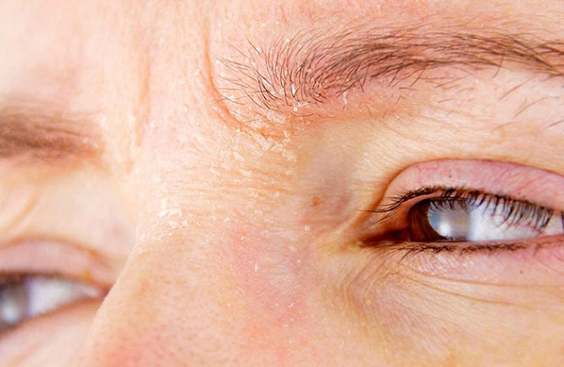 Da thiếu độ ẩm khiến vùng da quanh mắt bị ngứa ngáy và nóng rát