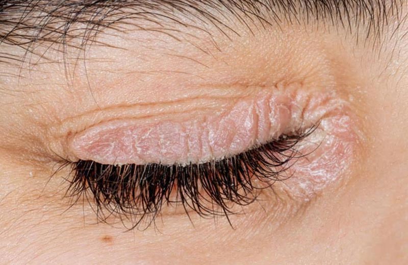 Vảy nến tại mắt dẫn đến vùng da quanh mắt bị đỏ ngứa